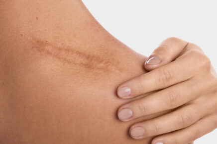 Online Shop für Narbengel, 19g